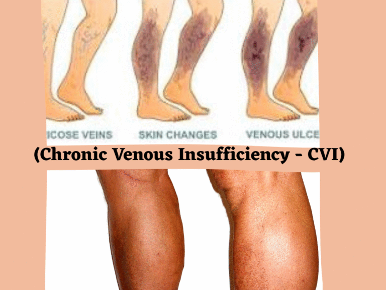 (Chronic Venous Insufficiency - CVI)